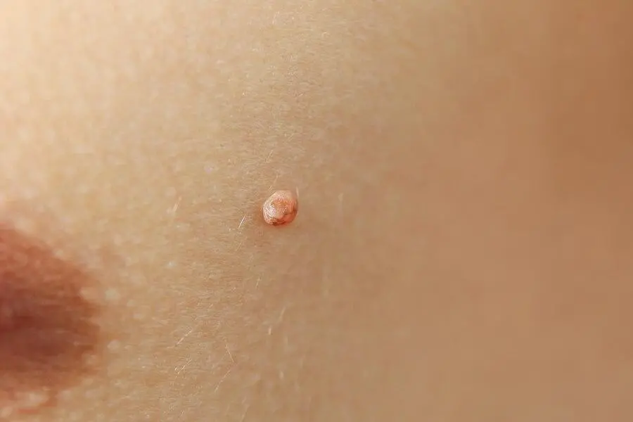 Skin Tag Removal